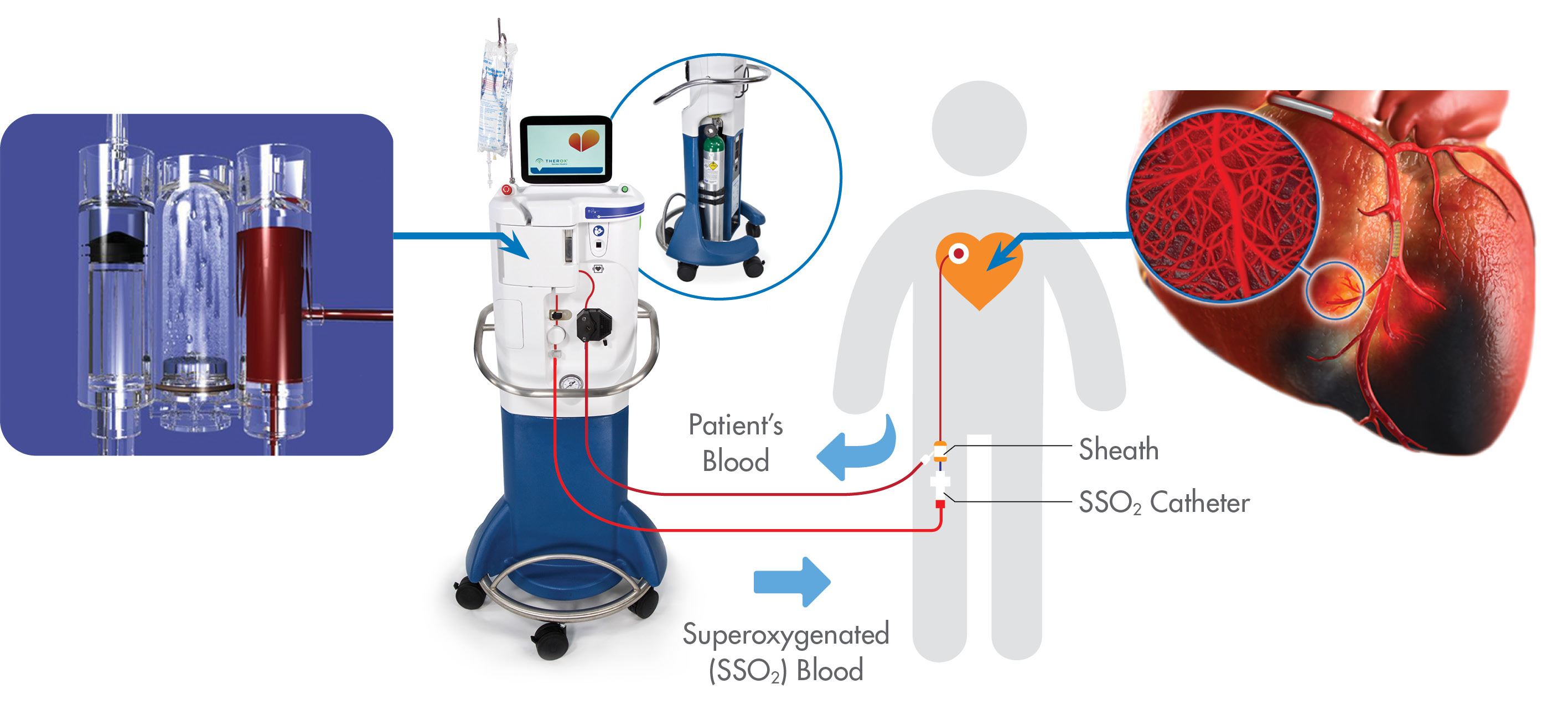 TherOx Procedure